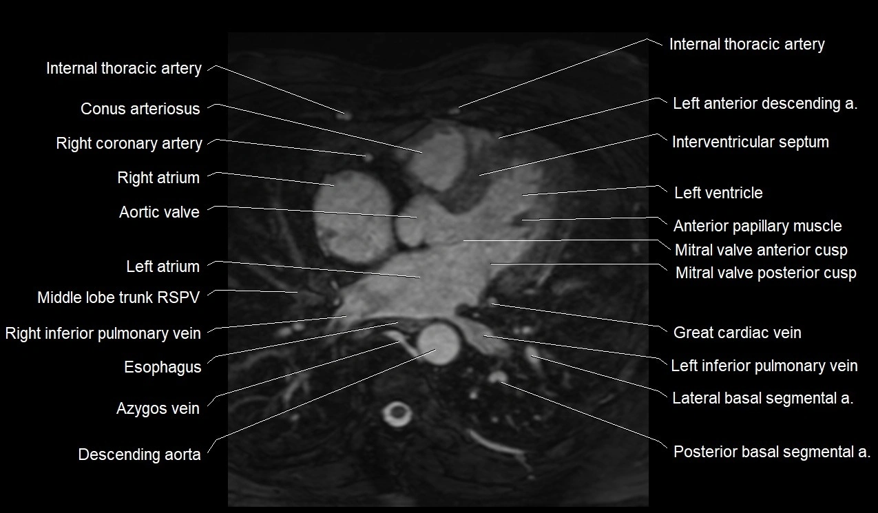 MRI heart coronary arteries and coronary veins anatomy axial image 23.webp